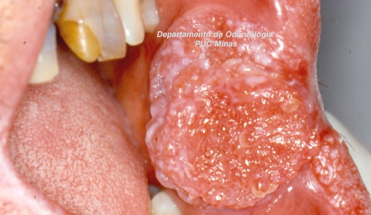 Quais são as lesões fundamentais da mucosa oral?
